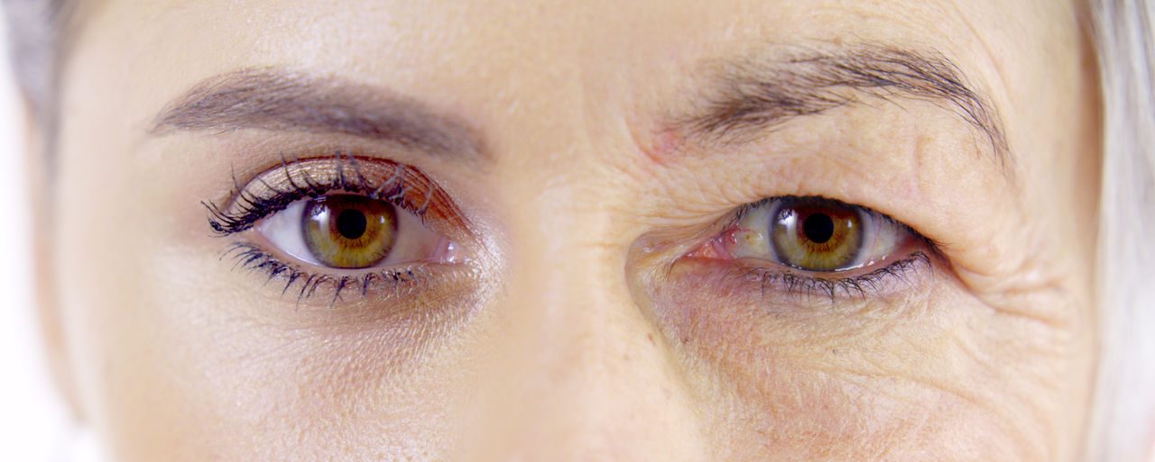 Frau mit Augensymptomen von Myasthenia gravis – mögliche Anzeichen